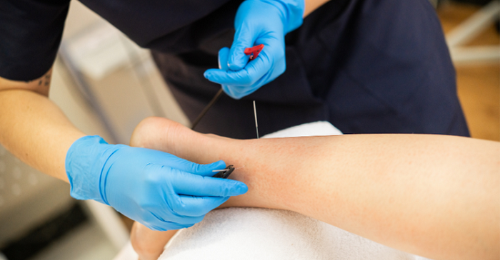 What Is Dry Needling And Why Is It Required?