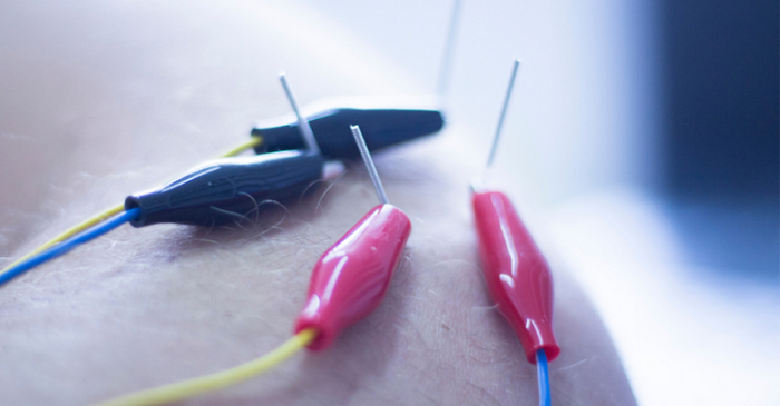 Dry Needling therapy